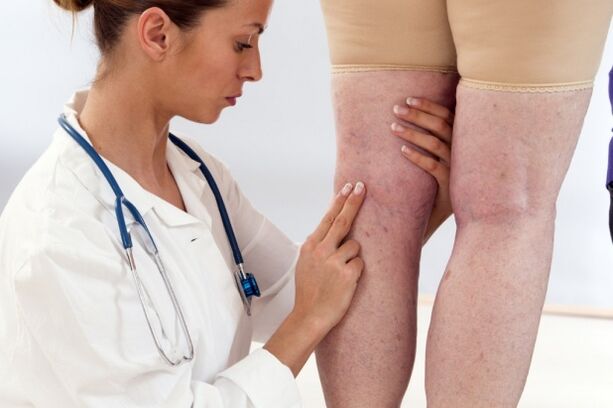 Treatment of varicose veins in women.