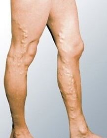 Varicose veins on the legs of a man.