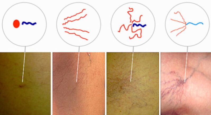 Spider veins in the initial stage of varicose veins.