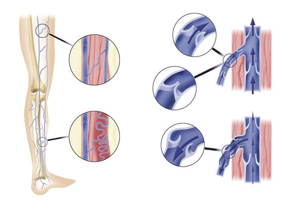 Incompetent venous valves cause varicose veins
