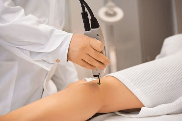 Laser coagulation of veins of the lower extremities.