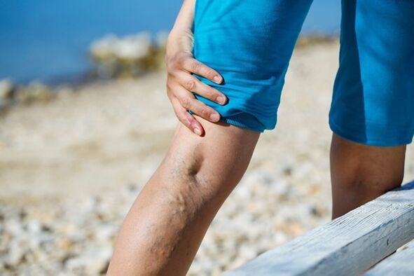 Persistent pain in the legs with varicose veins.