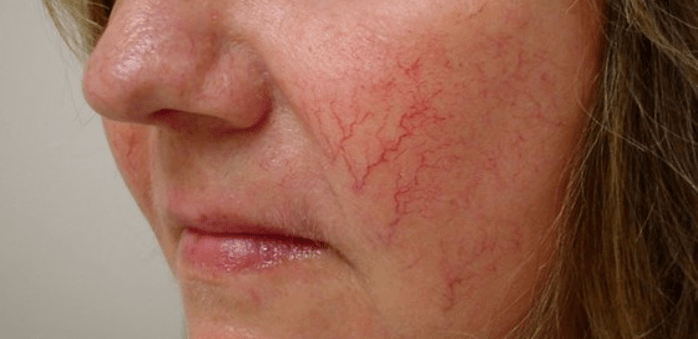 varicose veins on face how to treat