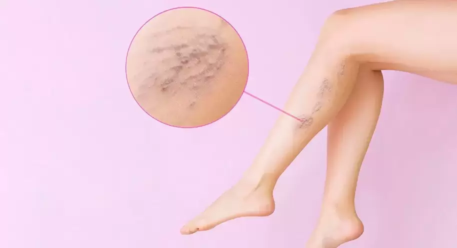 Crooked veins that bulge in the legs with varicose veins