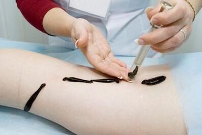 Leeches for varicose veins an effective remedy for traditional medicine. 