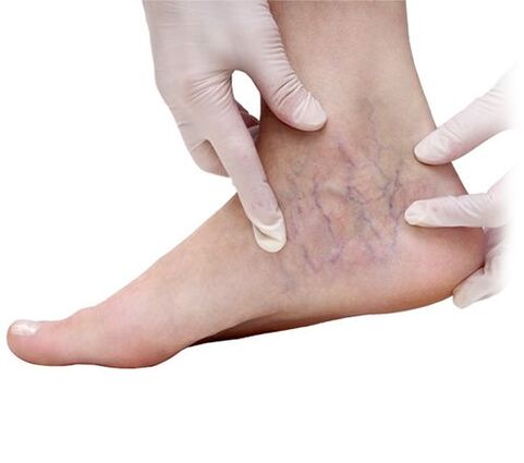 varicose vein diagnosis