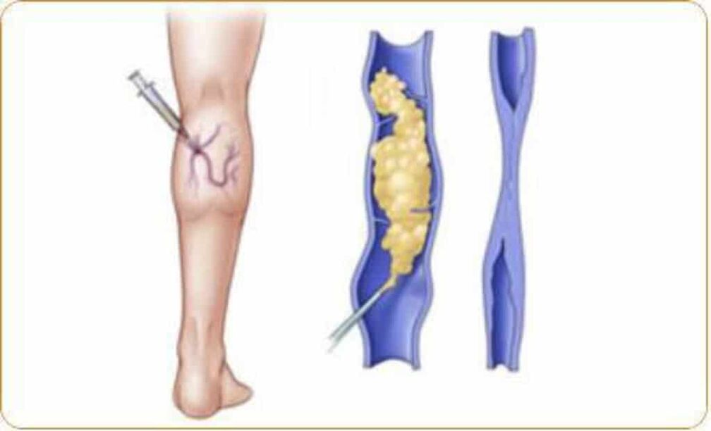 An example of the sclerotherapy procedure for varicose veins and a clear result. 