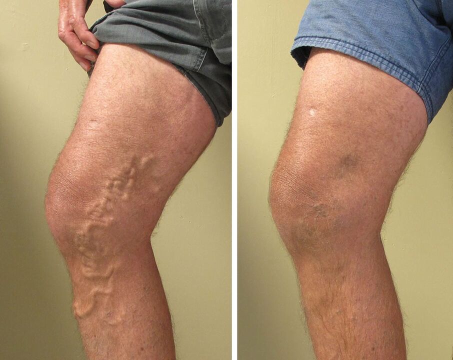 Varicose veins of the superficial vessels cannot be ignored. 