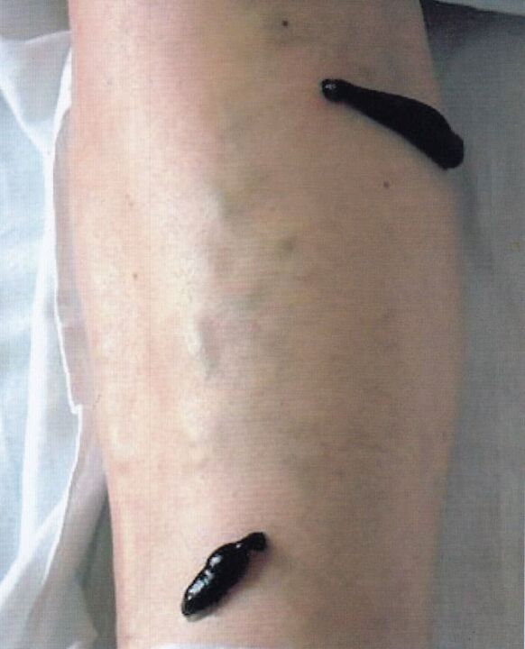 Hirudotherapy treatment of varicose veins in the legs with leeches. 